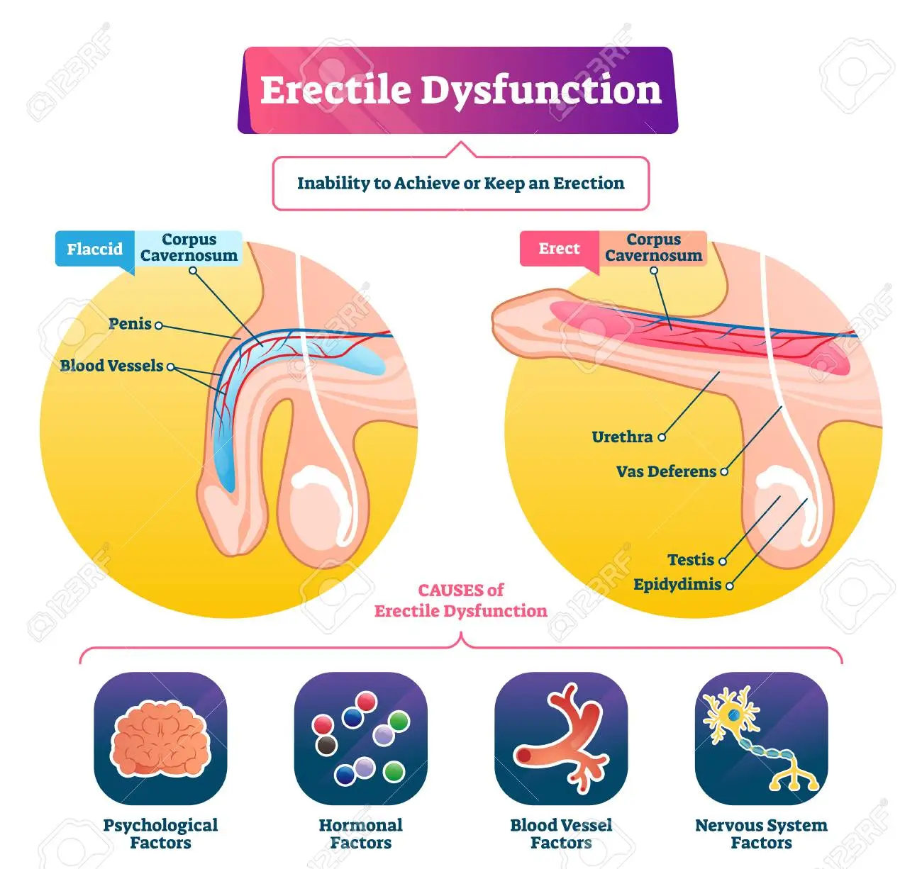 Erectyle Dysfunction 1