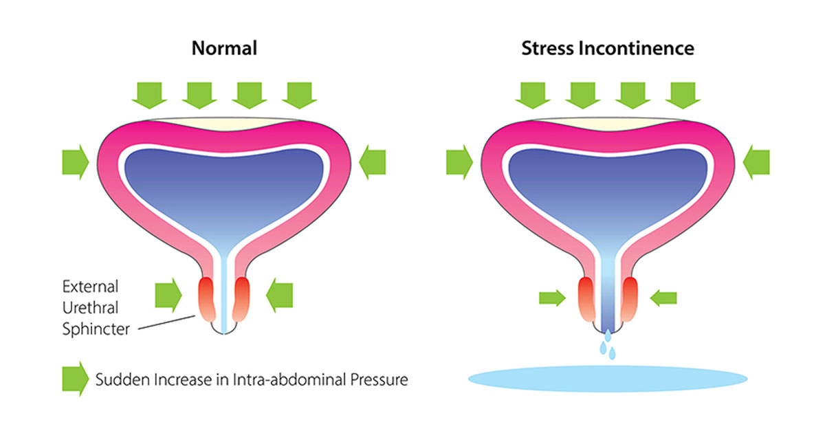 Female Stress Incontinence