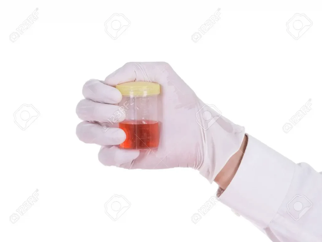 Hematuria 3