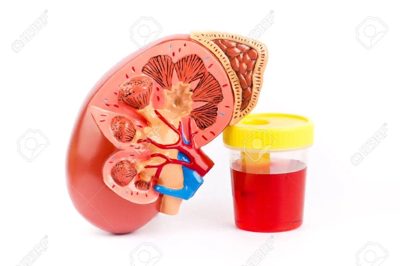 Hematuria