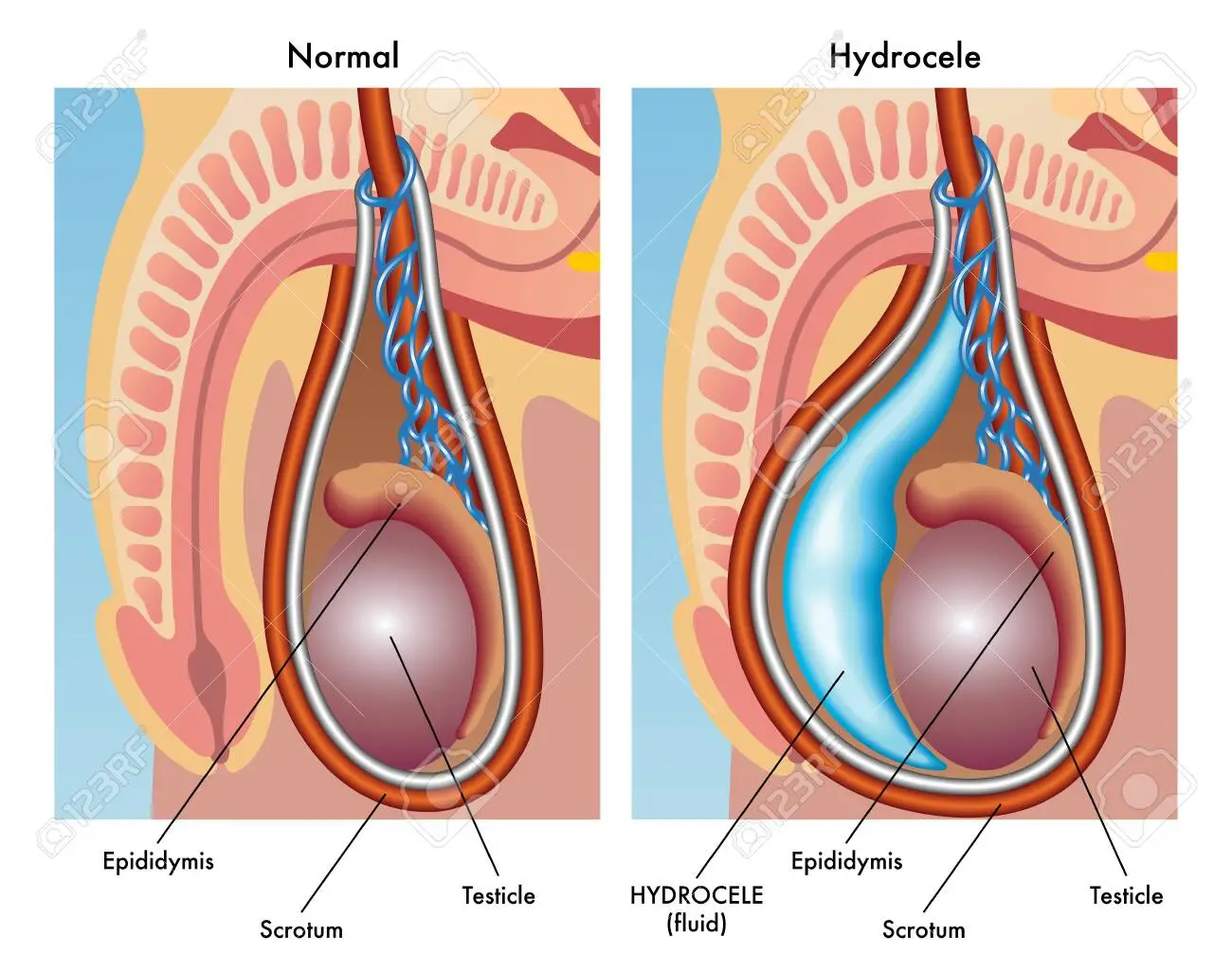 Hydrocele 1