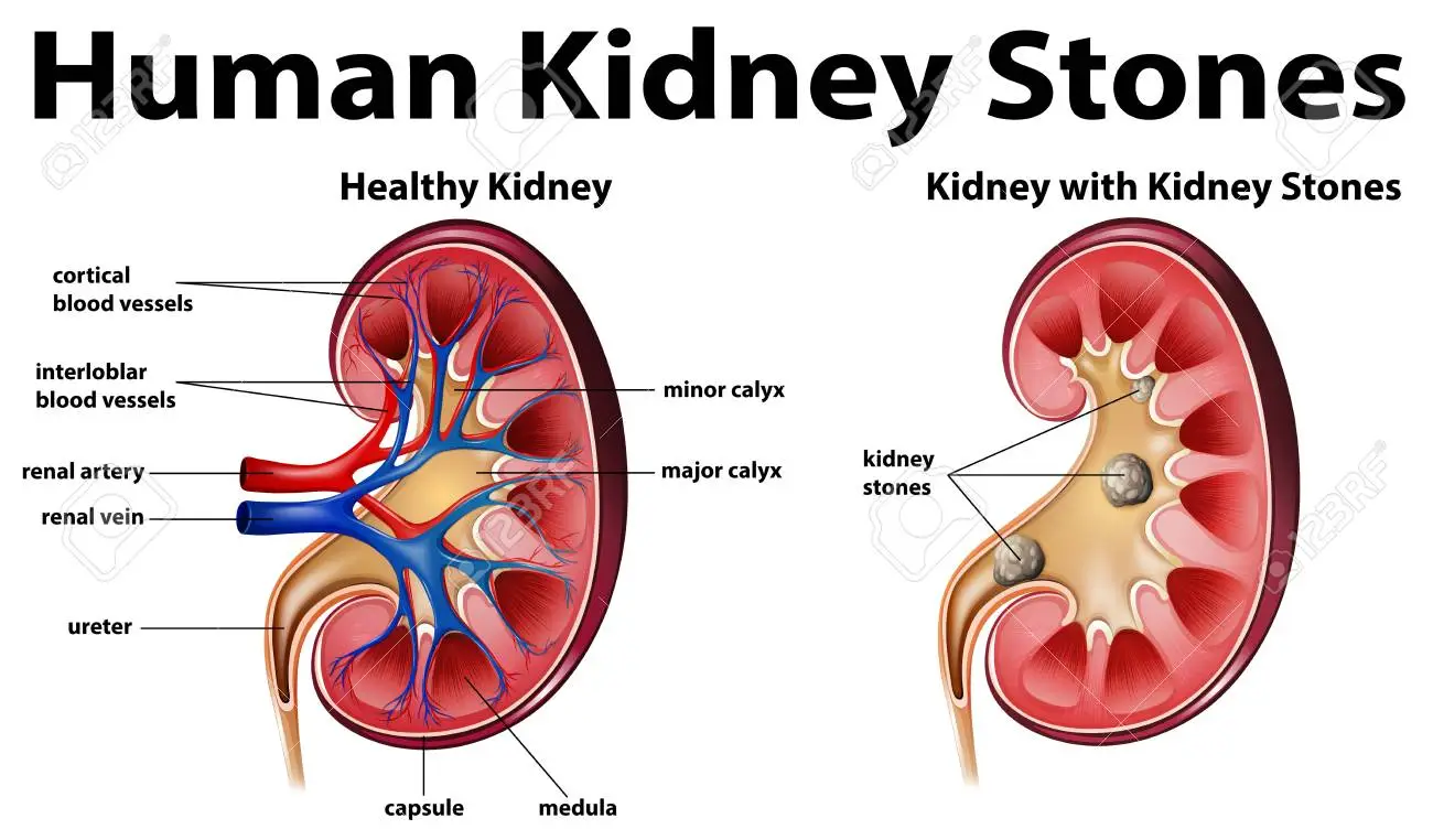 Kidney Stones 1