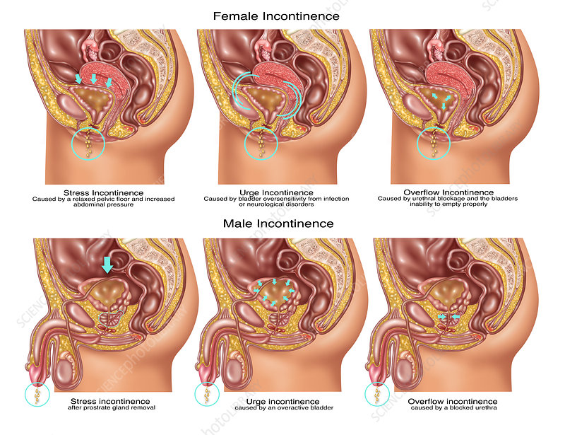 Types of Incontinence, Illustration