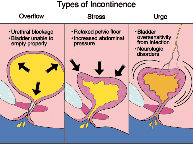 Overflow Incontinence Illustration