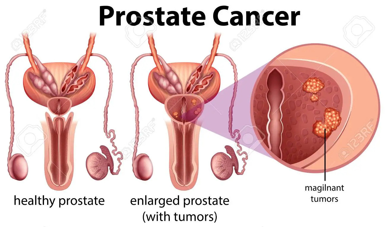 Prostate cancer 1