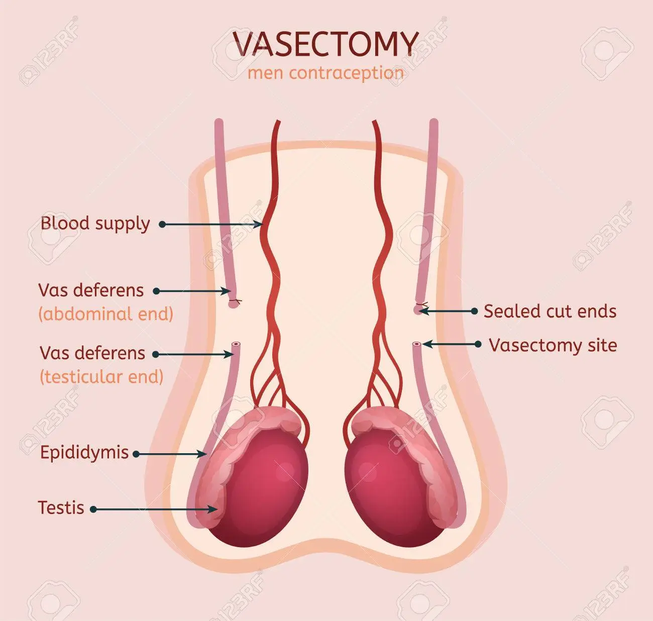 Vasectomy & Vas Reversal 1