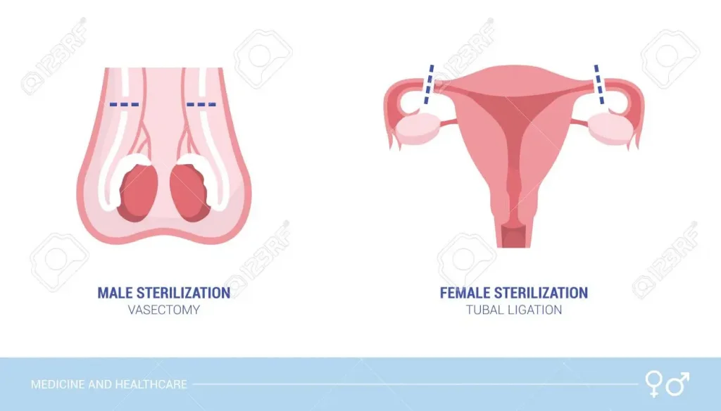 Vasectomy & Vas Reversal 3