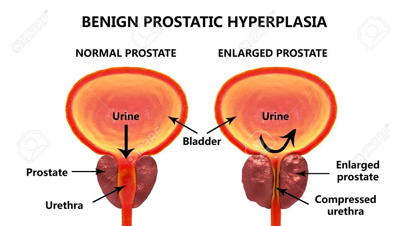 benign prostatic hyperplasia 1