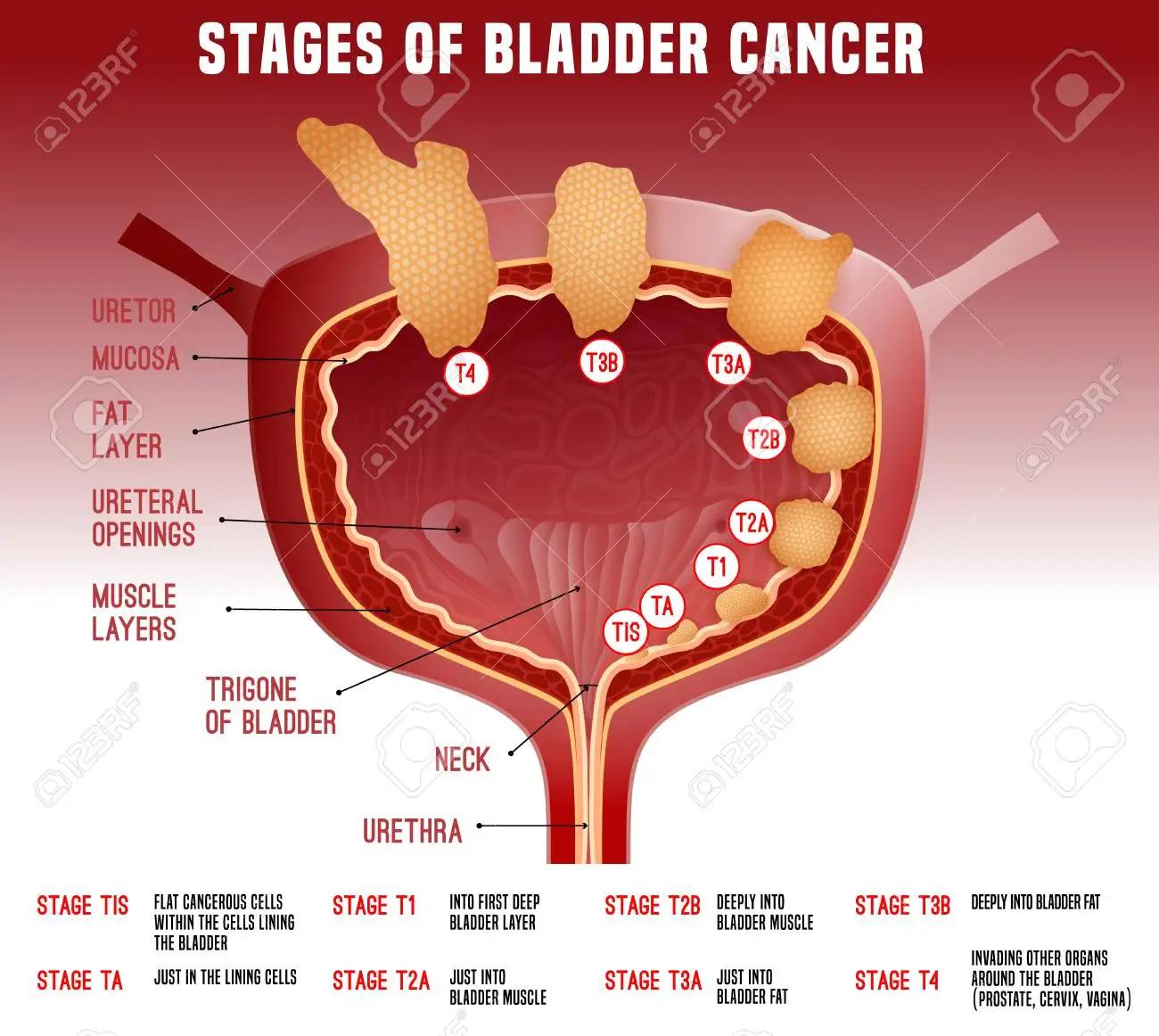 bladder cancer 1