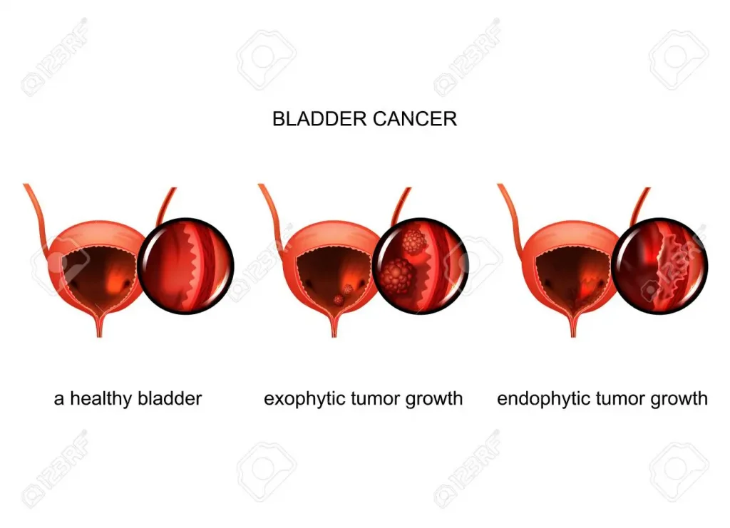 bladder cancer 3