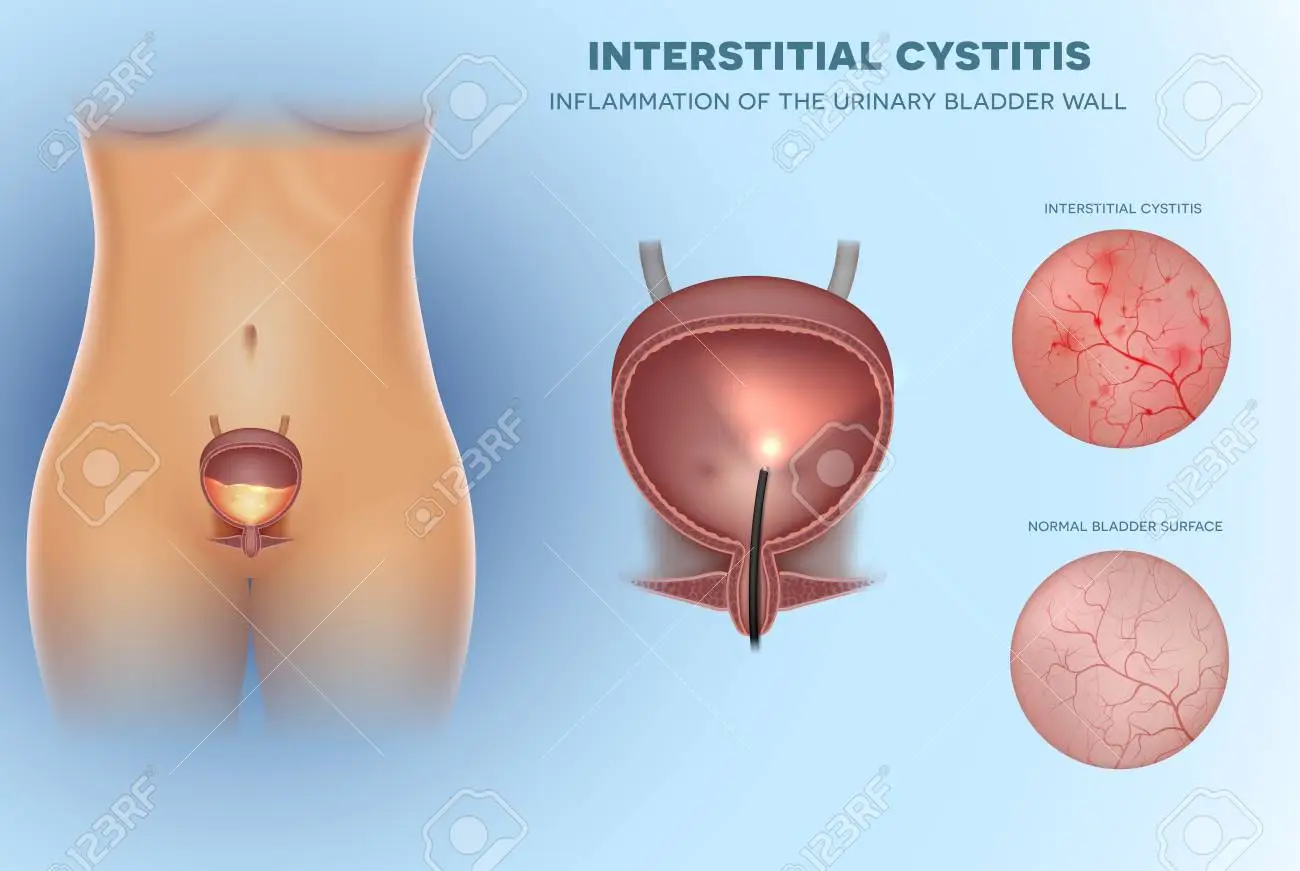 interstitial cystitis 1